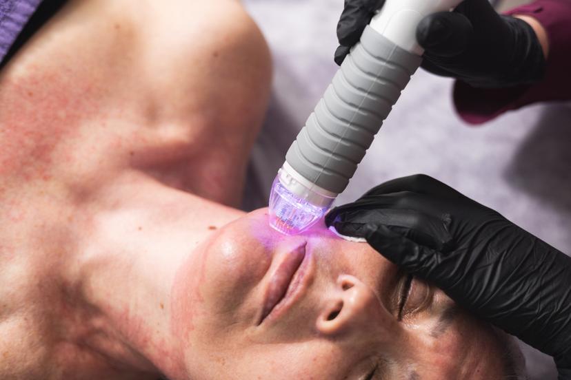 Vivace - sejas un ķermeņa ādas atjaunošanas procedūra