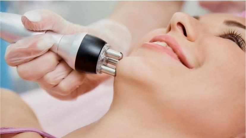 Bipolarā RF liftinga procedūra sejai un kaklam + fotoatjaunošana