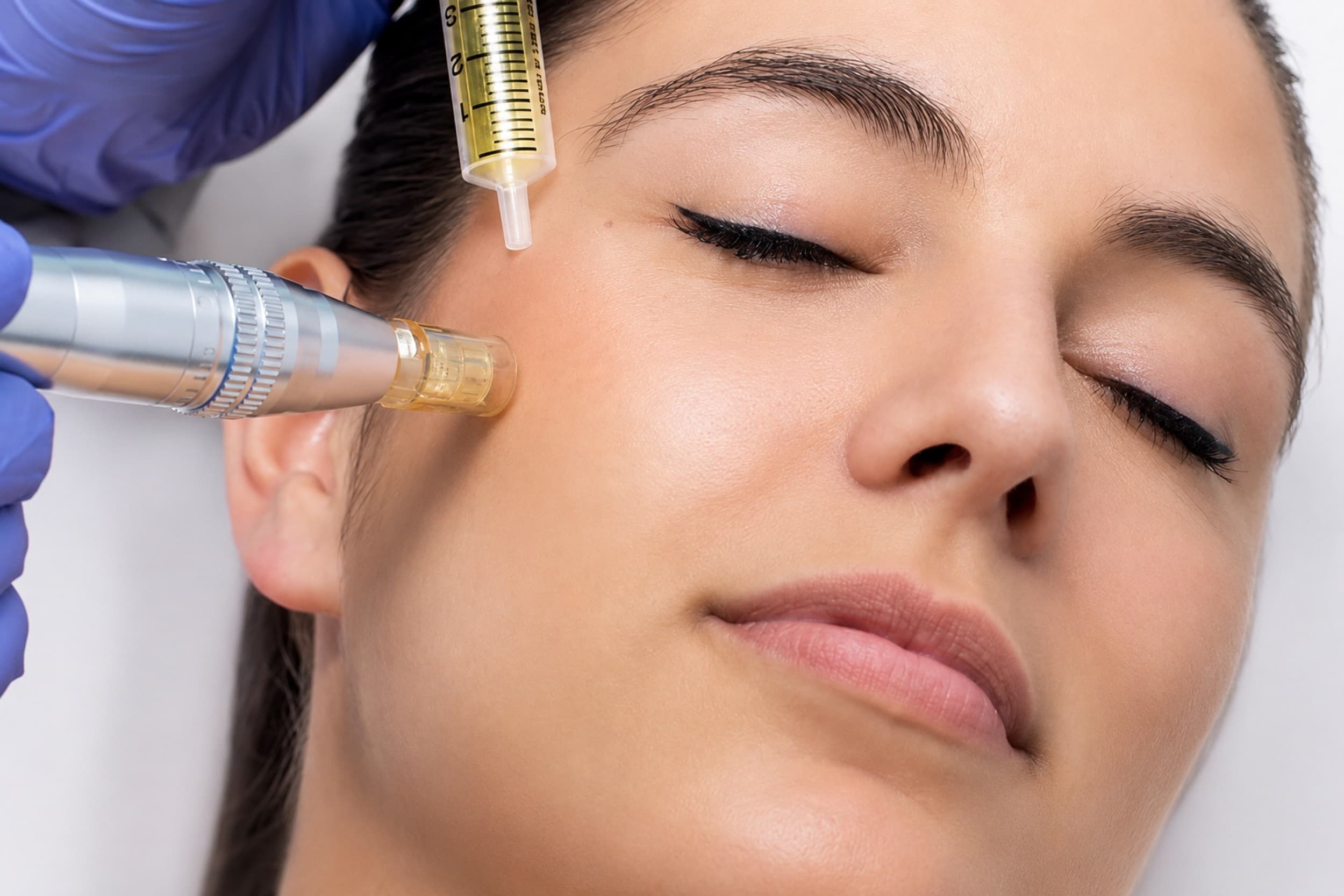 SkinRetin ādas atjaunošana (DermaPen, eksosomas) + lūpas
